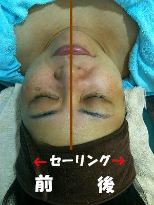 スッキリ 小顔 毛穴