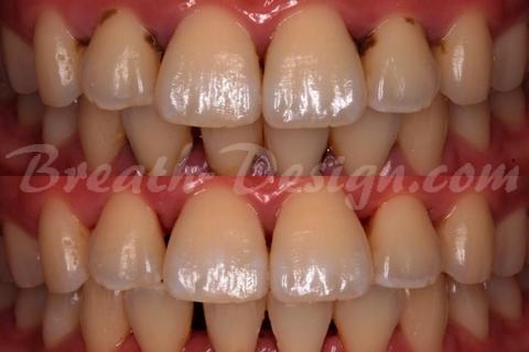 歯石 tartar(dental calculus)