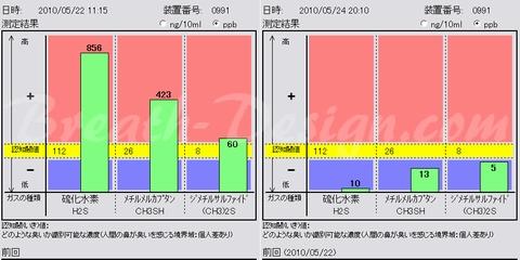 口臭治療 術前術後比較