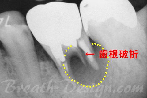 歯根破折