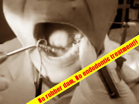 No rubber dam, no endodontic treatment