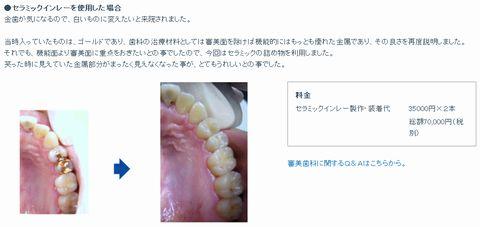 アクアデンタル 審美歯科症例 セラミックインレー