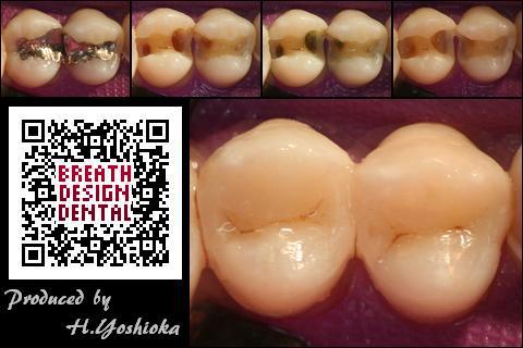 Hybrid-Direct (class 2 - posterior composite resin restorations) ハイブリッド インレー ダイレクト