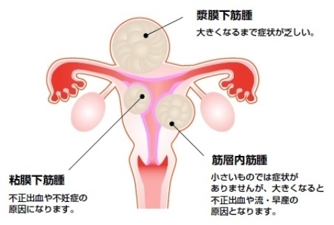 子宮筋腫 ビタミンD ビタミンA