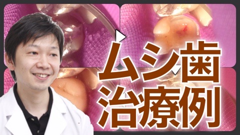 虫歯 新潟 長岡 ムシ歯