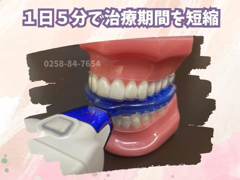 マウスピース矯正の加速装置「V Pro」 | 新潟長岡の歯科相談室 マウスピース矯正の加速装置「V Pro」 | 新潟長岡の歯科相談室
