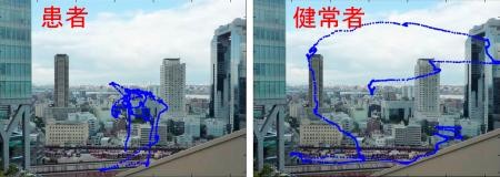 統合失調症と健常者との目の動きを比較