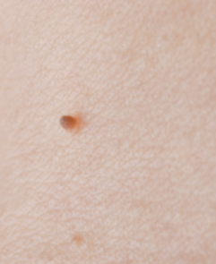 首の茶色いポツポツ ブツブツ 茶色いイボはこれで取れます アラフォー40代 美魔女の美容法 ネット通販でショッピング