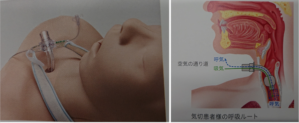 レティナカニューレ | どんぐりブログ