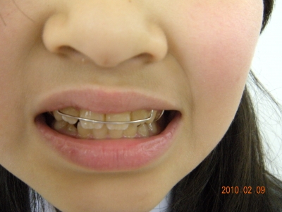 取外し式の矯正 桃井デンタルクリニック 東京都杉並区の一般 矯正歯科