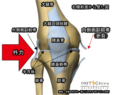 ない そく そく ふく 靭帯 損傷