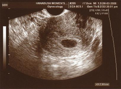 胎芽 見え 週 ない 7 【医師監修】胎嚢と胎芽が確認できる時期は？見えない時の原因について