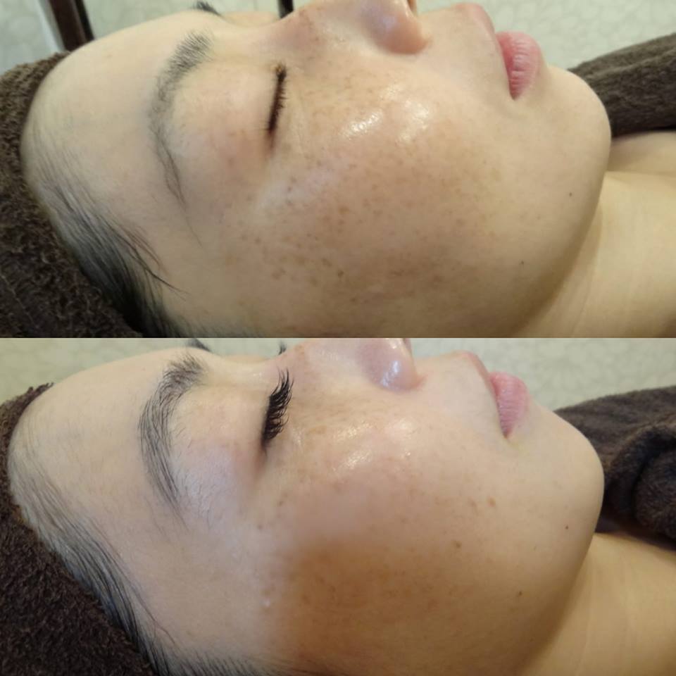 シミデトックストリートメント ビフォアフター Salon De You の日常