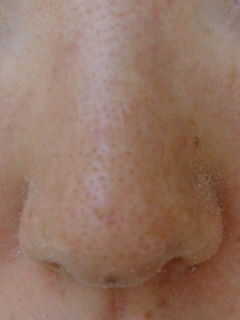 メモ55 角質培養だいたい9週間目画像 1リセットあり id