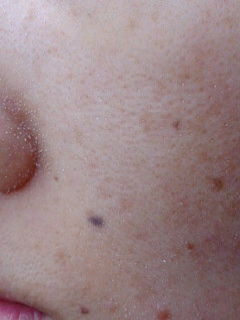 メモ45 角質培養だいたい8週間目画像 id