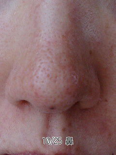 メモ76 超ゆる角質培養だいたい14週間目 id