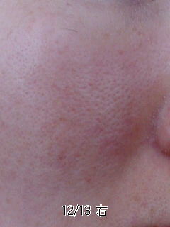 メモ83 ゆる角質培養だいたい21週間目 id