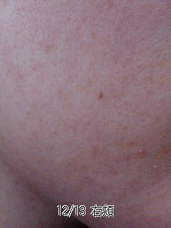 メモ83 ゆる角質培養だいたい21週間目 id