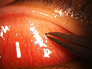 する ゴロゴロ 目 片目 だけ が 結膜結石という症状と対処方法 ゴロゴロな目