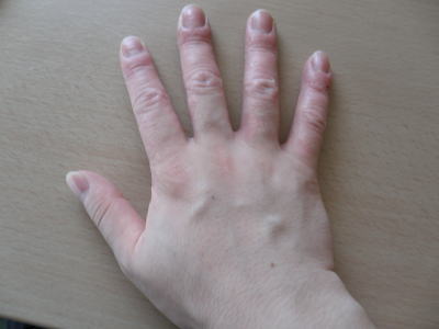 湿疹 かゆい 手の甲
