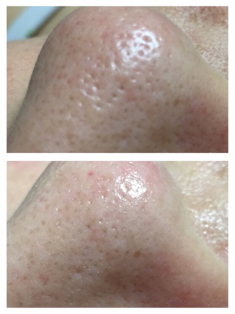 毛穴洗浄 鼻 ほほ あご 交野市 枚方市 寝屋川市 京田辺市 まつげパーマ 全身脱毛 メンズヒゲ脱毛 Sally 内川恵美