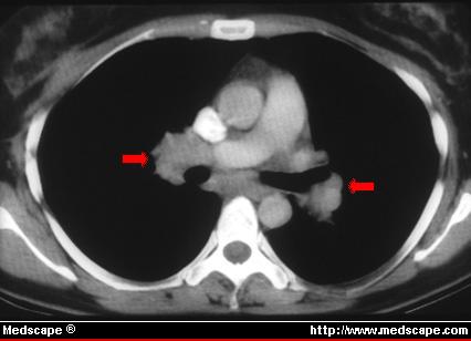 BHL-CT