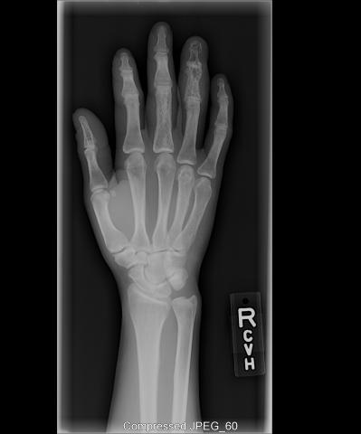 fracture_sarcoidosis