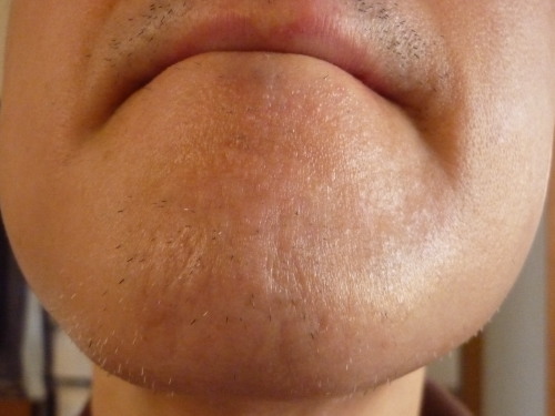 15年07月の記事 男の裏活動 今は ヒゲ 脱毛 白髪