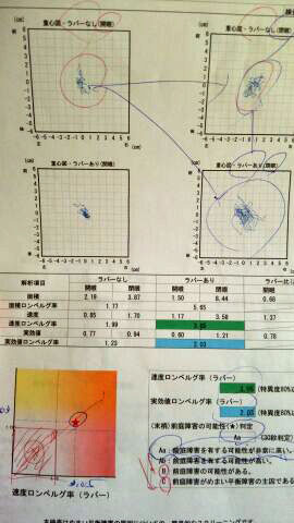 めまいの検査3