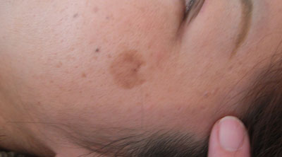 お月様みたいな大ーきなシミ ローズマリーに咲いた笑顔と元気