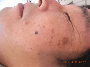 中年男性によく見る 真っ黒くて出っ張ったシミ ローズマリーに咲いた笑顔と元気