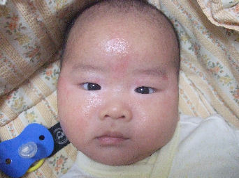2ヶ月 乳児湿疹途中報告 フウライ日記