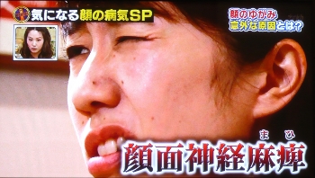 顔面神経麻痺