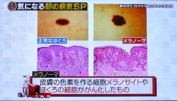 メラノーマとはメラノサイトやほくろの細胞ががん化したもの