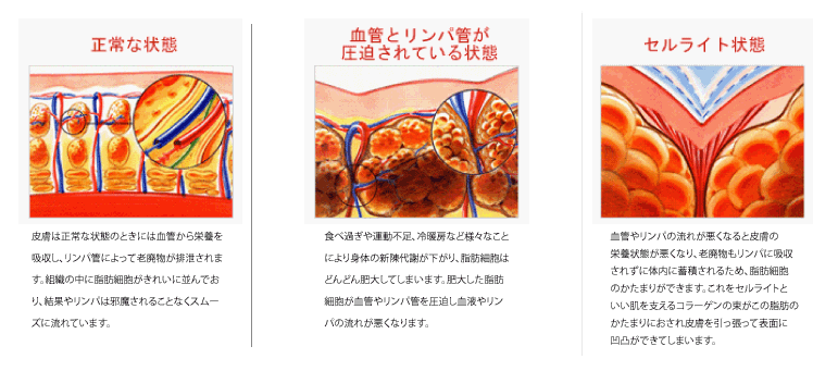 どのようにセルライトはできる?