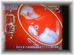 膿栓 のうせん