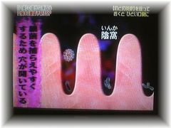 膿栓を作る陰窩(いんか)