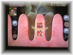 陰窩にできた膿栓のイメージ