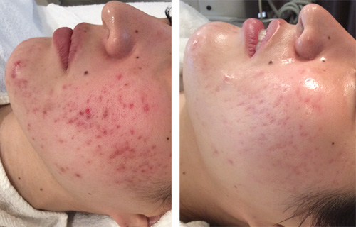 フェイシャル 美顔 素肌新館ブログ