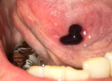 舌 の 裏 口内炎 原因
