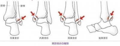骨折 果 関節 足 外