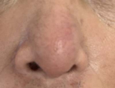 ニキビに ミラブルプラス あい らぶリフォーム