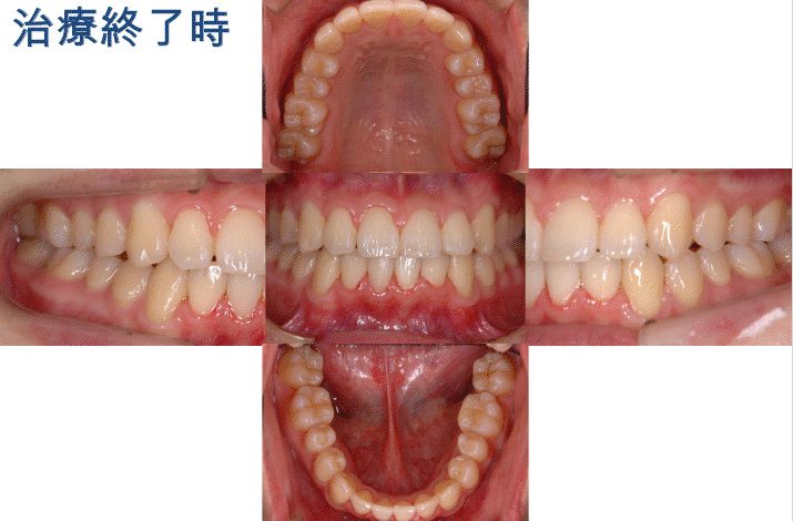 矯正治療1治療後