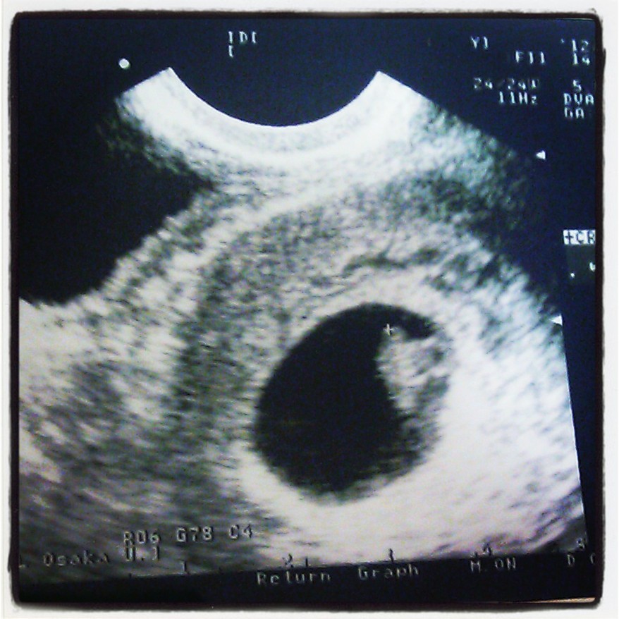 胎芽 見え 週 ない 7 妊娠７週のエコーの見方！心拍弱い・胎芽が小さくても無事に成長する？