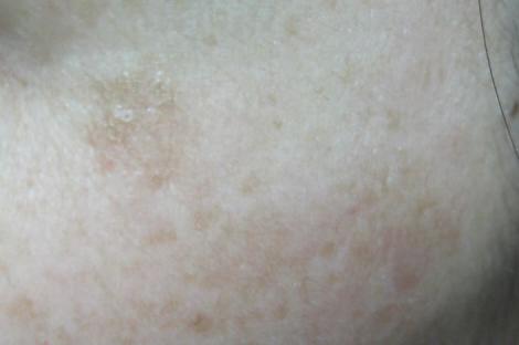 １カ月で顔のシミが消えるか 実践レポート 汚部屋お片付けブログ