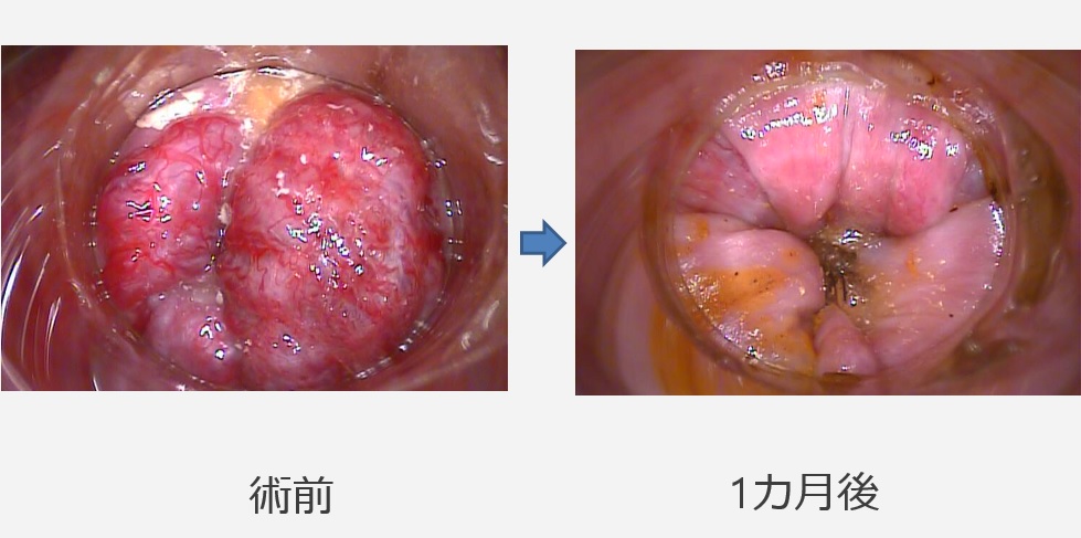 注射 術 後 ジオン