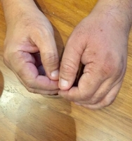 左手腫脹