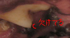 欠けた奥歯
