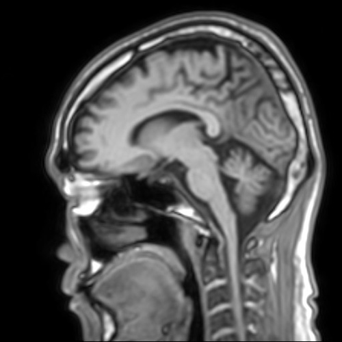 MRI1