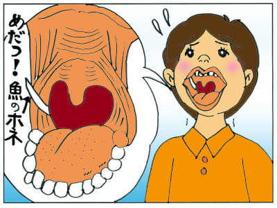 のどちんこ(口蓋垂筋)脇に刺さった魚の骨